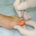 Проблема врастающих ногтей на ногах – правила лечения и профилактики