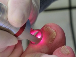 Как лечить грибок ногтей на руках