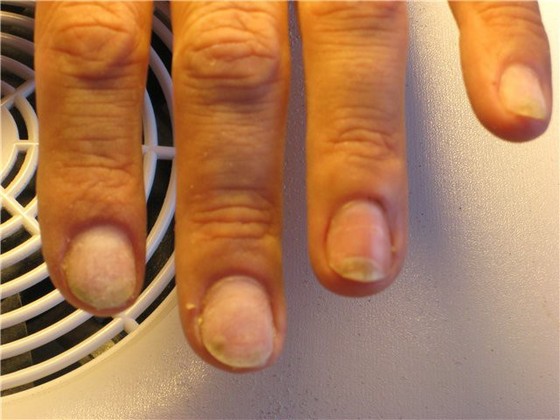Признаки грибка ногтей на руках