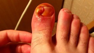 Симптомы вросшего ногтя на ноге